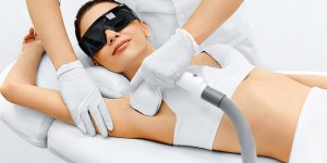 Лазерная эпиляция