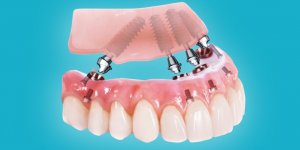 Что собой представляет имплантация ALL-ON-4?